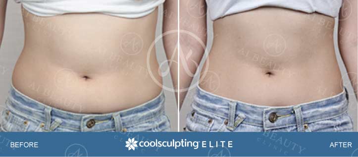 Coolsculpting before and after