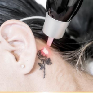 PicoSure Tattoo Removal