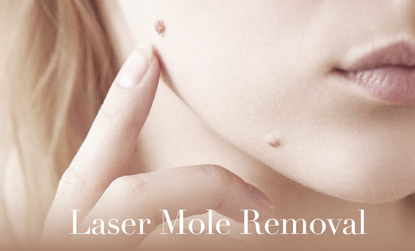 Laser mole removal