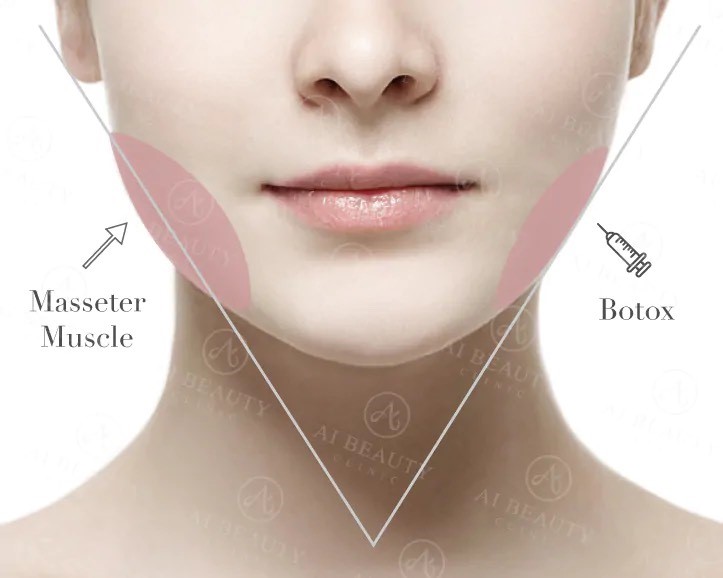 masseter botox